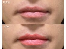 ライム 中野(LIME)/ローマピンク｜黒ずみケア