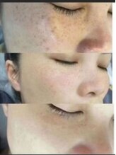 エムズビューティスタジオ エステ リラク 西川口店(M's Beauty Studio)/シミを改善しました