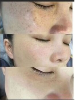 エムズビューティスタジオ エステ リラク 西川口店(M's Beauty Studio)/シミを改善しました