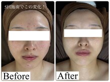 人気の毛穴ケア、ハーブピーリング♪ヘッドスパも大人気♪