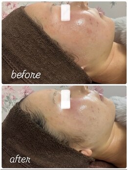 イロドリ(IRODORI)/REVIハーブピーリング