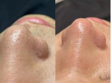 アイブロウドット 川口店(iBROW.)の雰囲気（パーツ脱毛も人気です！角質角栓や産毛が取れてツルツルに*.）