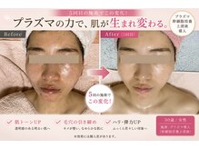 ルベル(Luvelle)の雰囲気(プラズマで肌が生まれ変わります)