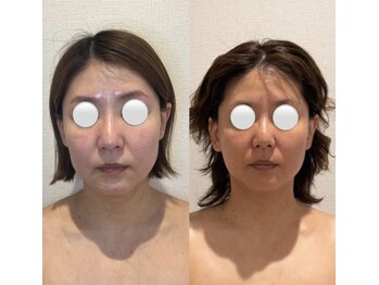 エレミュー 烏丸(Elemue.)の写真/【とことん結果にこだわる】徹底リフトアップ×根本改善を目指す方へ!加齢のサインは顔の下半分に現れる!?