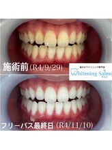 ホワイトニングサロン 熊本店/手軽にホワイトニング