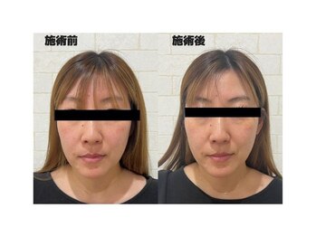 楽美身/リフトアップ