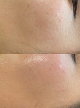 ナチュライズ(NatuRise)/赤ちゃんのようなピカピカ肌へ