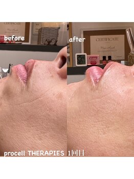 ケステ(Keste)/プロセルセラピーズ　肌質改善