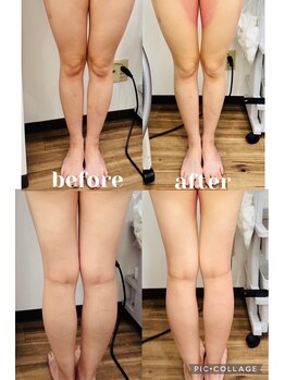 アモ(amo)/脂肪冷却2回目施術後★