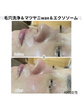 メリナ(Melina)/毛穴洗浄&マツヤニ&エクソソーム