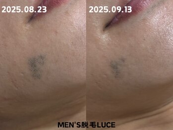 ルーチェ/【ヒゲ脱毛】1度の照射で