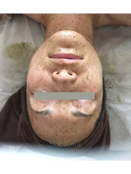 ノットノット 自由が丘(Not Knot)/グリーンピール５デイズ直後