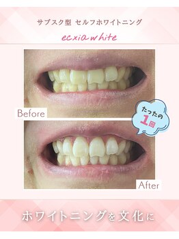 エクシアホワイトニング 江坂店/ビフォーアフター