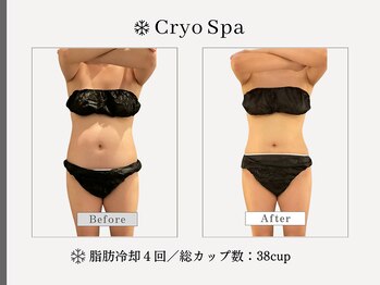 クリオスパ せんげん台駅前店(Cryo Spa)/脂肪冷却
