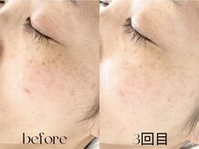 シュリ(Shri)/イロンショートカットピーリング