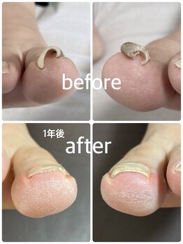 股関節が悪い方 巻き爪