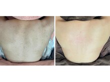 シェリル 松江店(CHARIRE)/ハーブピーリング/毛孔性苔癬