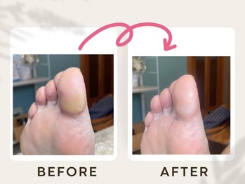 ドクターネイル爪革命 恵庭店/たこケア