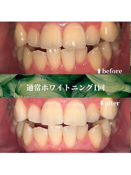 フタバ 天神大名店(futaba)/初回ホワイトニングbefore after