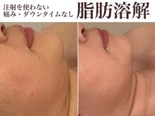 マヴィ(Ma vie)の雰囲気（二重顎やほうれい線・たるみを脂肪分解により、徹底的に改善◆）