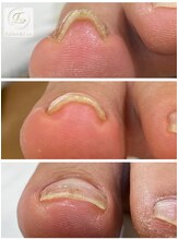 サロン アンド ルクス(Salon & Lux)/巻き爪ケア