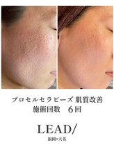 リードスラッシュ(LEAD/)/