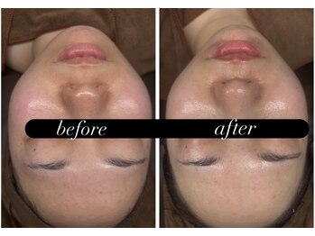 ビノスビューティー(vinos.beauty)/症例写真　レストセルTR