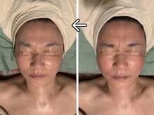 ルーチェ(LUCE)/小顔リフトUP/小顔矯正/筋膜