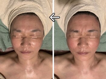 ルーチェ(LUCE)/小顔リフトUP/小顔矯正/筋膜