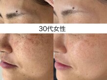 シミケア専門店 SAKURA 平塚店/30代後半　3回目