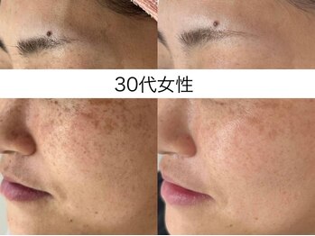 シミケア専門店 SAKURA 平塚店/30代後半　3回目