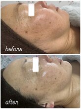 イロドリ(IRODORI)/REVIハーブピーリング