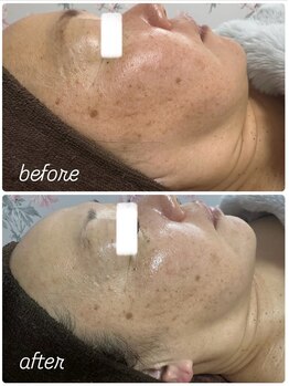 イロドリ(IRODORI)/REVIハーブピーリング