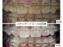 ホワイトニングショップ 明石大久保店/【BeforeAfter】10回券のお客様