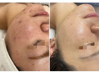 アヌエヌエ(aNueNue)/ニキビケア症例