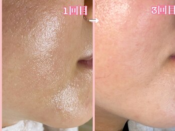 ララン(Laran)/ハイドラ&フォト