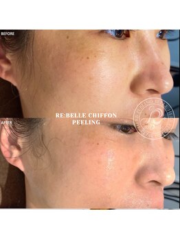 クリア 麻布十番(CLEAR)/◆根本から肌質改善◆乾燥肌