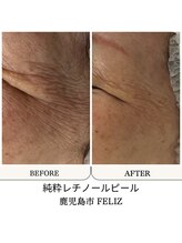 フェリス(FELIZ)/シワたるみ改善