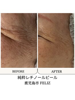 フェリス(FELIZ)/シワたるみ改善