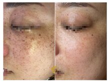 しらゆき 名古屋黒川/シミケア