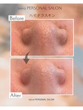 トイロ(toiro)/毛穴洗浄　ハイドラスキン