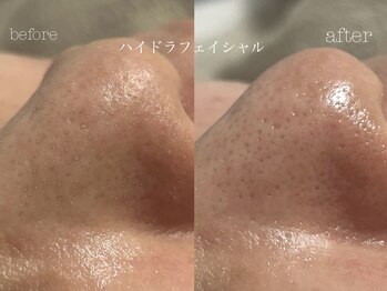 キアラ(CHIARA)/ハイドラフェイシャル