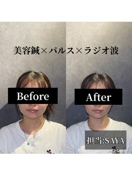 クリアランス 南青山(CLEARANCE)/1回の施術効果 担当SAYA