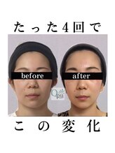 キュープ 函館店(Qpu)/美顔器モニターコース4回の変化