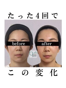 キュープ 函館店(Qpu)/美顔器モニターコース4回の変化