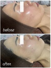 イロドリ(IRODORI)/REVIハーブピーリング