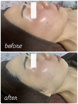 イロドリ(IRODORI)/REVIハーブピーリング