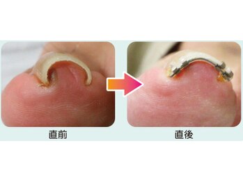 【巻き爪矯正】1回目
