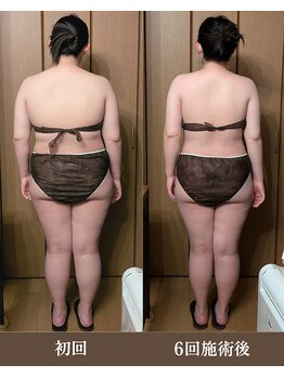 ルマ(Rumah)/凝り固まった巻き肩を脂肪分解