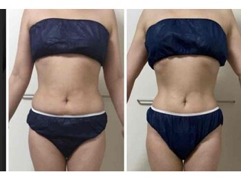 美宝 元町の写真/くびれが欲しいならコレ！ぽっこりお腹・浮き輪肉を本気で変える結果重視！お腹が変わると毎日が変わる◎